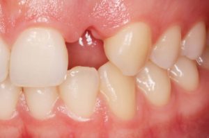 ausencia diente superior